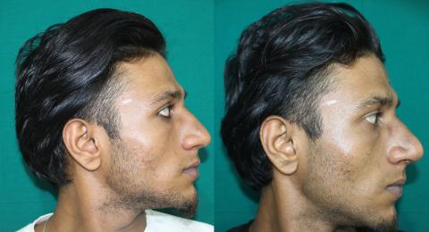 Cosmetic Rhinoplasty