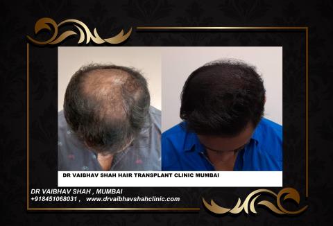 Hair Transplant