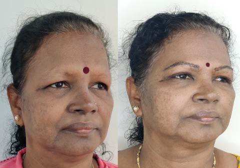 EYELID SURGERY