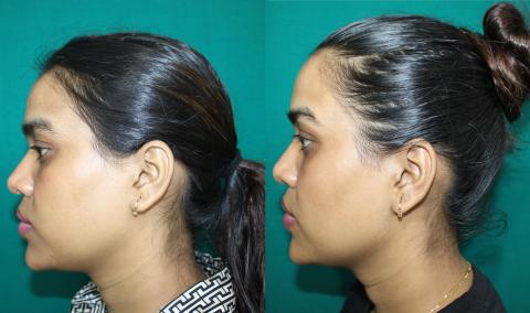 FACE SCULPTING AND CHIN IMPLANT