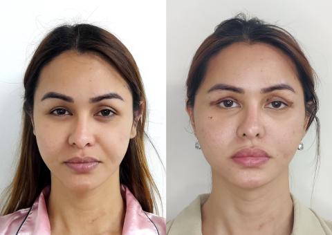 Facelift, Neck Lift