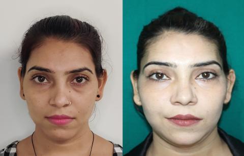 FACIAL FEMINIZATION SURGERY