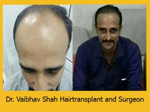 Hair transplant in mumbai result
