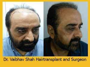 Hair transplant in mumbai result 2
