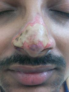 nose-surgery-in-mumbai-india