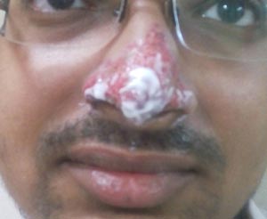 nose-surgery-in-mumbai-india