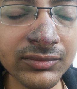 nose-surgery mumbai india usa uae