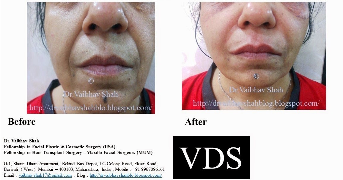 Best Non surgical facelift clinic mumbai result