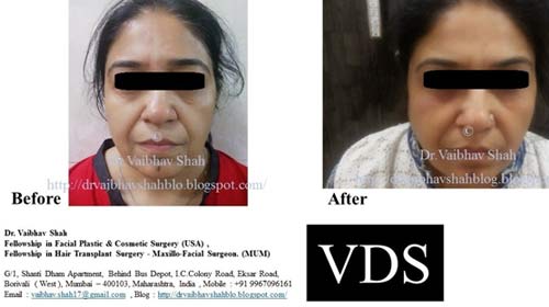 Facelift Surgery in India - Dr Vaibhav Shah