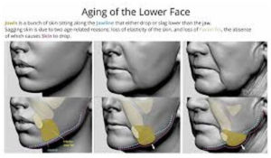 Few indications of facelift surgery is Aging-on-face