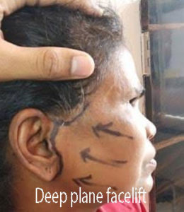 Deep plane facelift