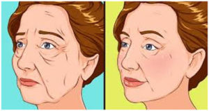 Few indications of facelift surgery is Sagging-on-face.